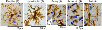 The dual function of microglial polarization and its treatment targets in ischemic stroke